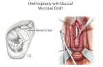 Comparing Ventral and Dorsal Oral Mucosal Graft Urethroplasty in Female Urethral Stricture
