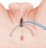 Perineal Urethrostomy