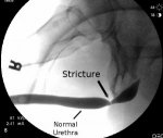 Urethral Strictures after Endoscopic Urological Surgery