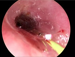 DCB optilume for Urethral Stricture Review